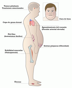 sintomas de cushing artricenter
